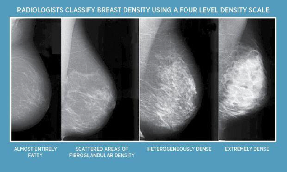 Bi rads 2 acr 2. Маммография классификация bi-rads. Диффузная мастопатия маммография. Кистозная мастопатия маммография. Bi-rads 3 молочной железы маммограмма.